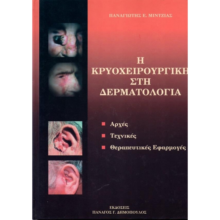 Η Κρυοχειρουργική στη Δερματολογία