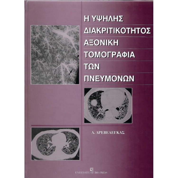 Η Υψηλής Διακριτικότητος Αξονική Τομογραφία