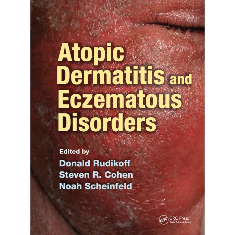 Atopic Dermatitis and Eczematous Disorders 1st Edition