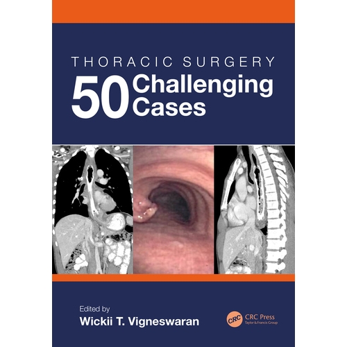 Thoracic Surgery: 50 Challenging cases