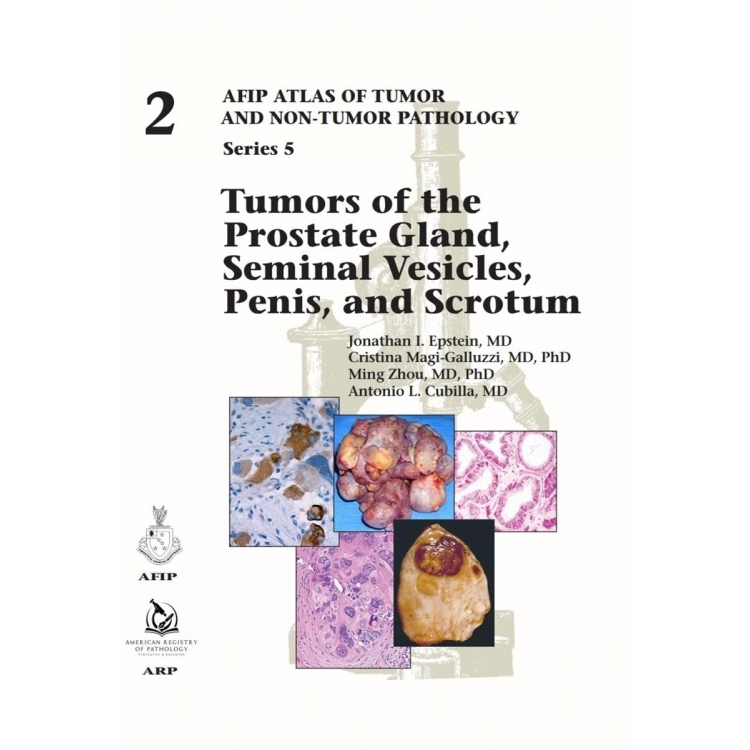 Tumors of the Prostate Gland, Seminal Vesicles, Penis, and Scrotum