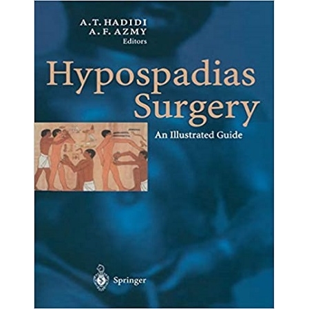 Hypospadias Surgery An Illustrated Guide