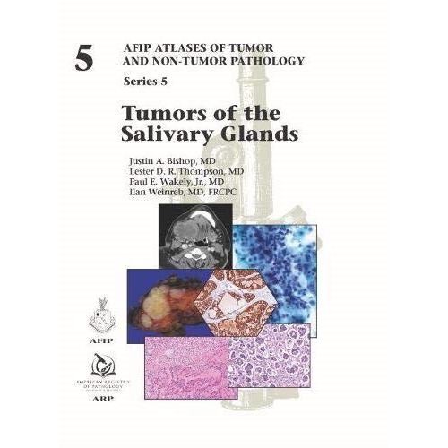 Tumors of the Salivary Glands
