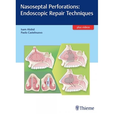 Nasoseptal Perforations Endoscopic Repair Techniques