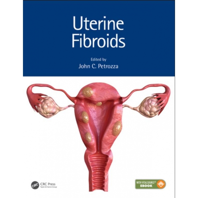 Uterine Fibroids