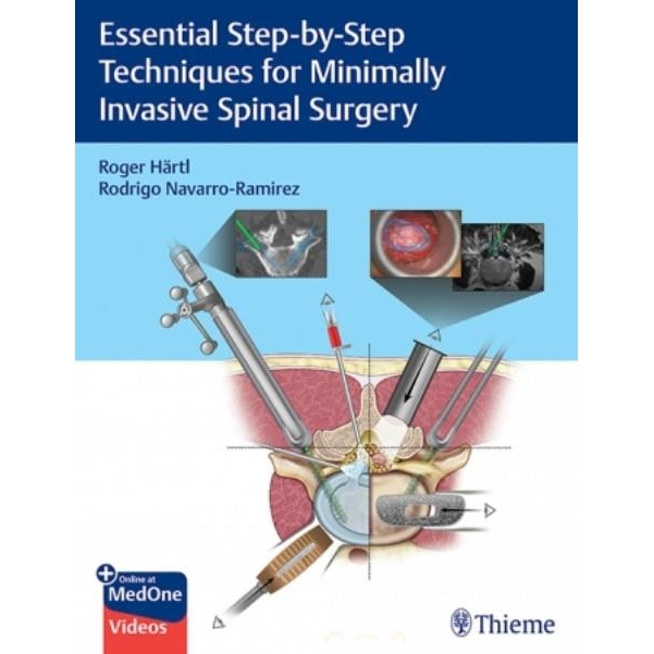Essential Step-by-Step Techniques for Minimally Invasive Spinal Surgery