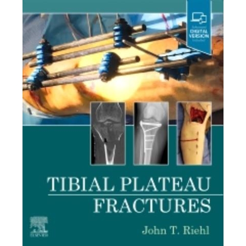 Tibial Plateau Fractures