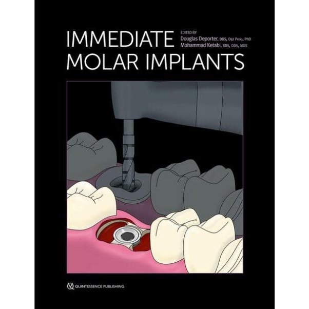 Immediate Molar Implants