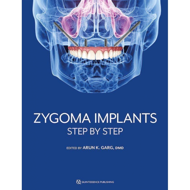 Zygoma Implants, Step by Step, 1st Edition