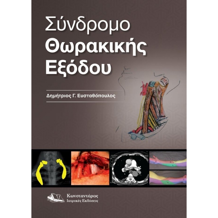 Σύνδρομο Θωρακικής Εξόδου