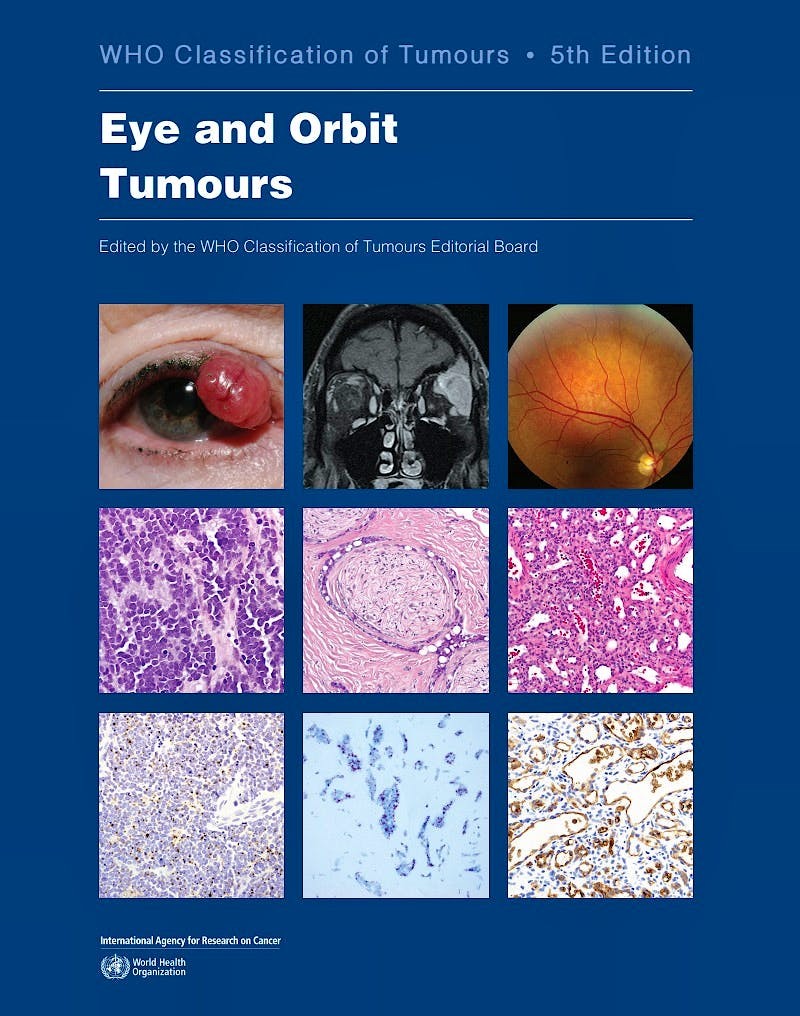 WHO Classification of Tumours: Eye and Orbit Tumours, 5th Edition