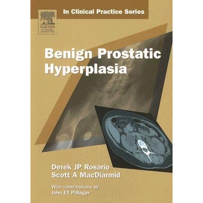 Benign Prostatic Hyperplasia, 1st Edition