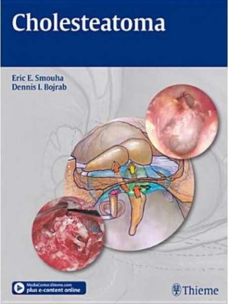 Cholesteatoma