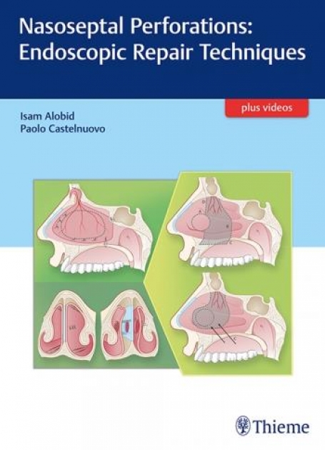 Nasoseptal Perforations Endoscopic Repair Techniques